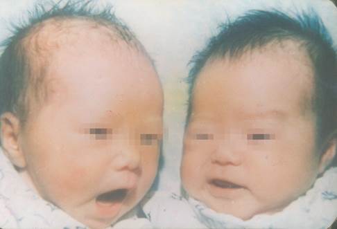 说明: 1989年9月在本院出生的广东省首二例试管婴儿_副本.jpg